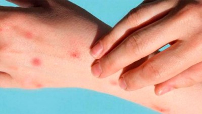 Confirmaron el primer caso de viruela del mono en la provincia de Santa Fe