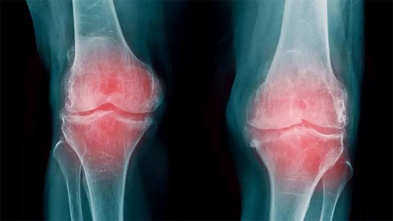 Consiguen identificar la progresión de la artrosis con un análisis de sangre