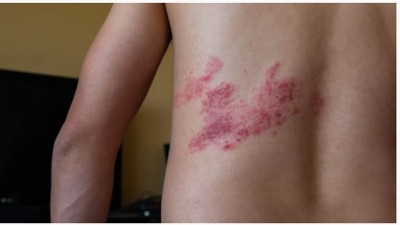Causa picazón, dolor y hormigueo: herpes Zóster, la enfermedad que afecta a una de cada tres personas