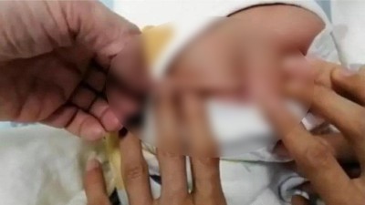 Bebé nació con una cola de 10 centímetros creciendo desde su espalda