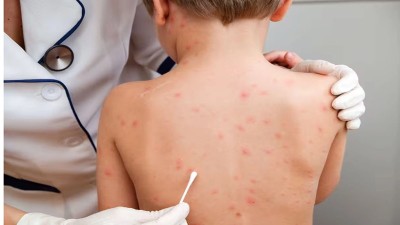 Preocupa el avance de Sarampión: a quiénes incluiría el plan de vacunación